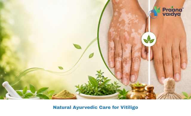 Ayurvedic Treatment for Vitiligo: A Holistic Approach to Skin Balance